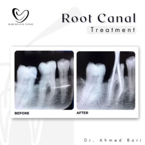 Root Canal Treatment