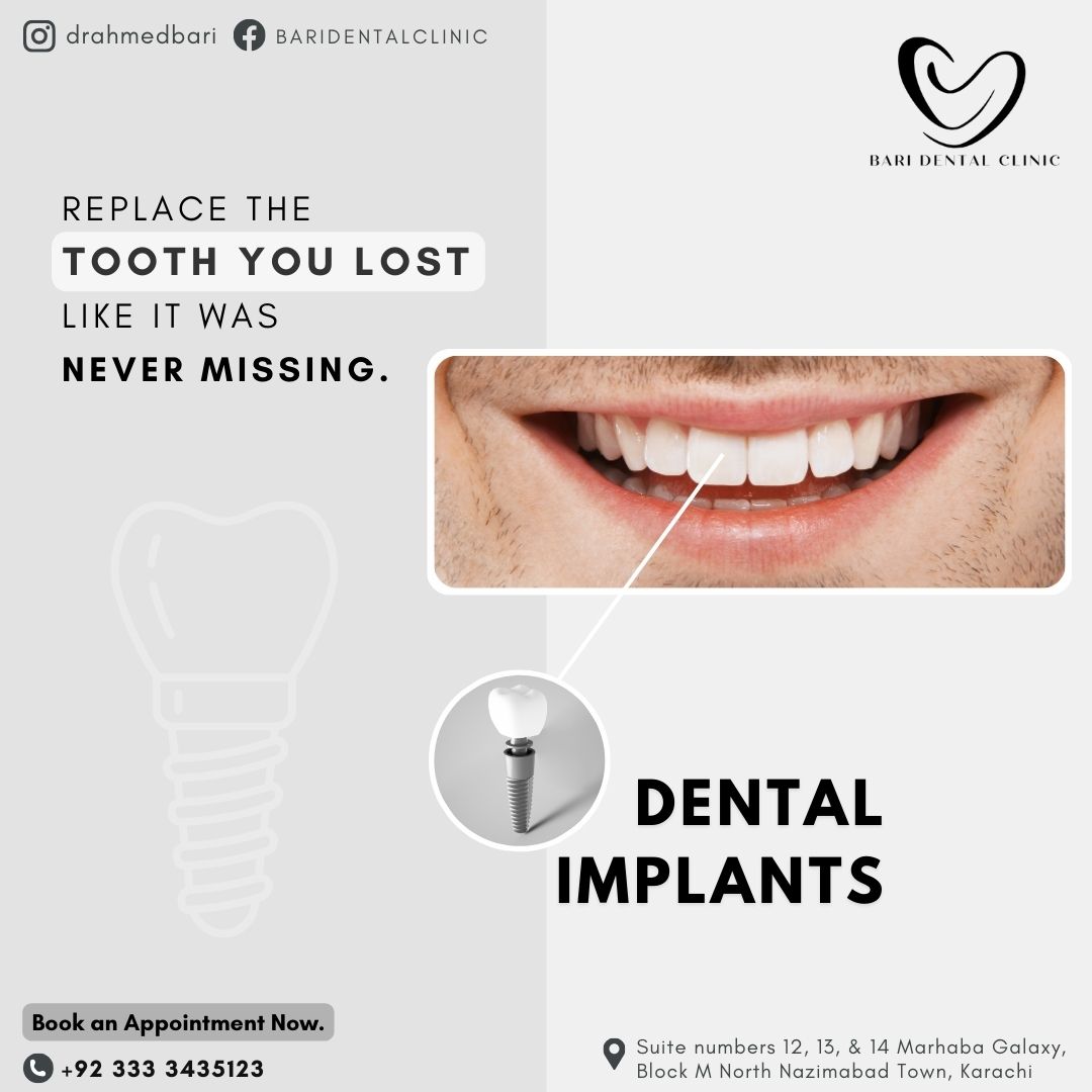 dental implants