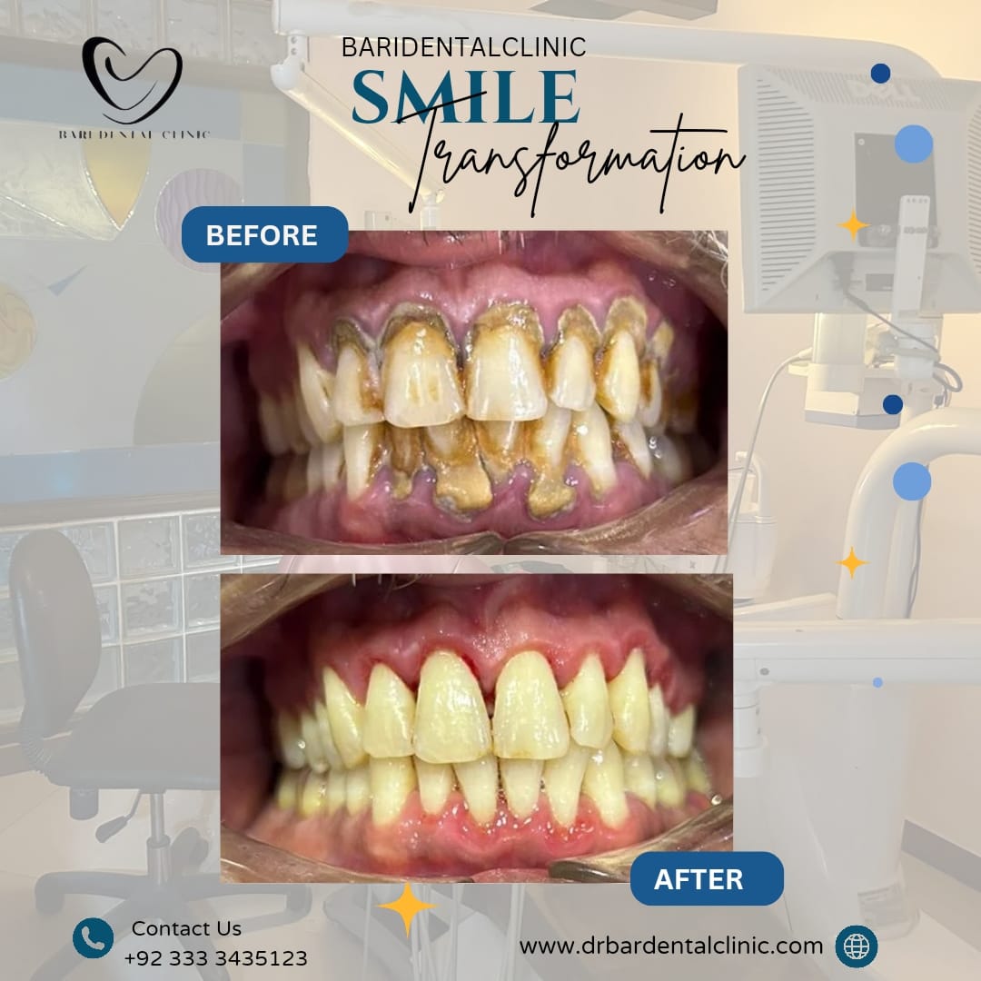 Dental Plaque Removal