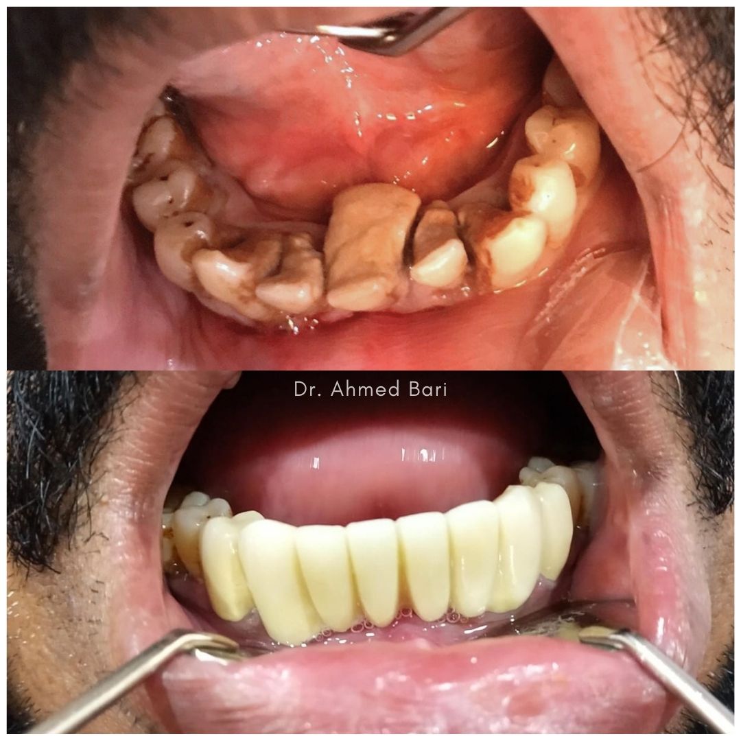 Teeth Disease