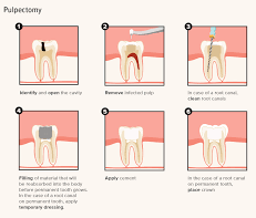 Pulpectomy of Tooth