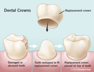 Dental Crowning