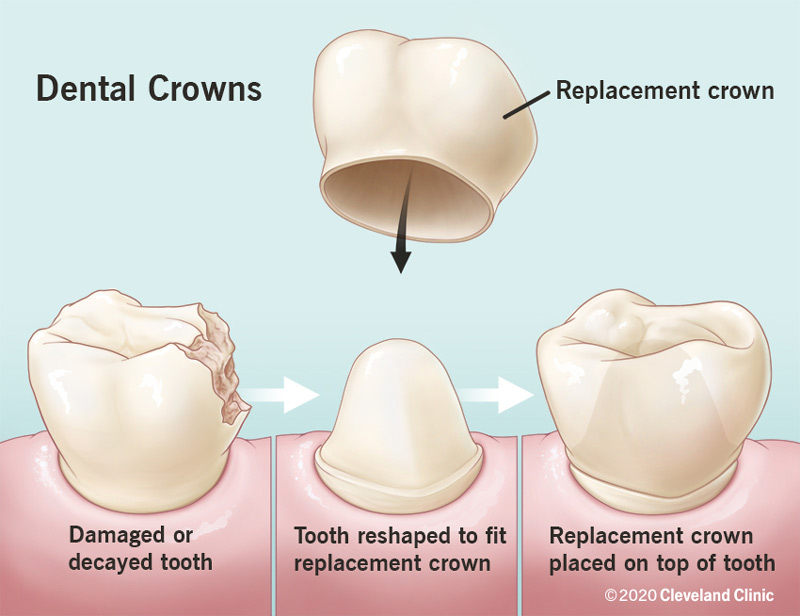 Dental Crowning: Restore and Protect Your Teeth